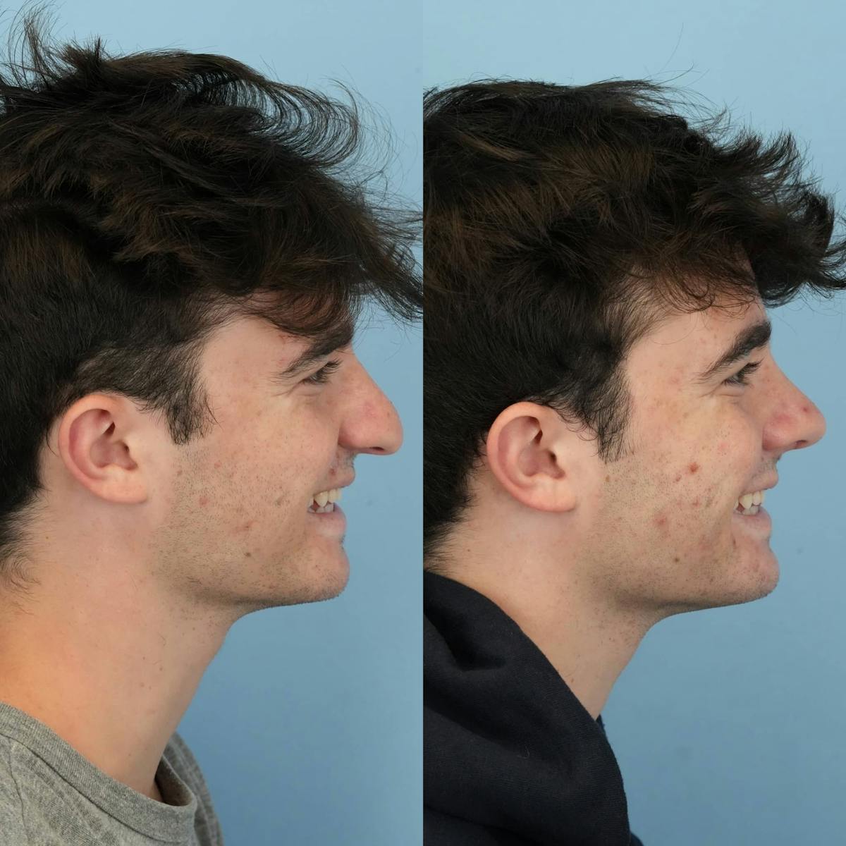 Rhinoplasty Before & After Gallery - Patient 253009 - Image 6