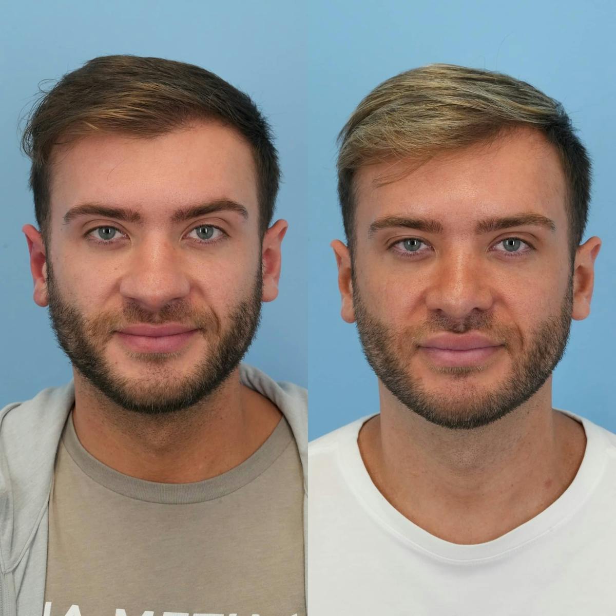 Rhinoplasty Before & After Gallery - Patient 167408 - Image 1