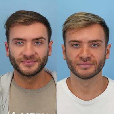 Rhinoplasty Before & After Gallery - Patient 167408 - Image 1