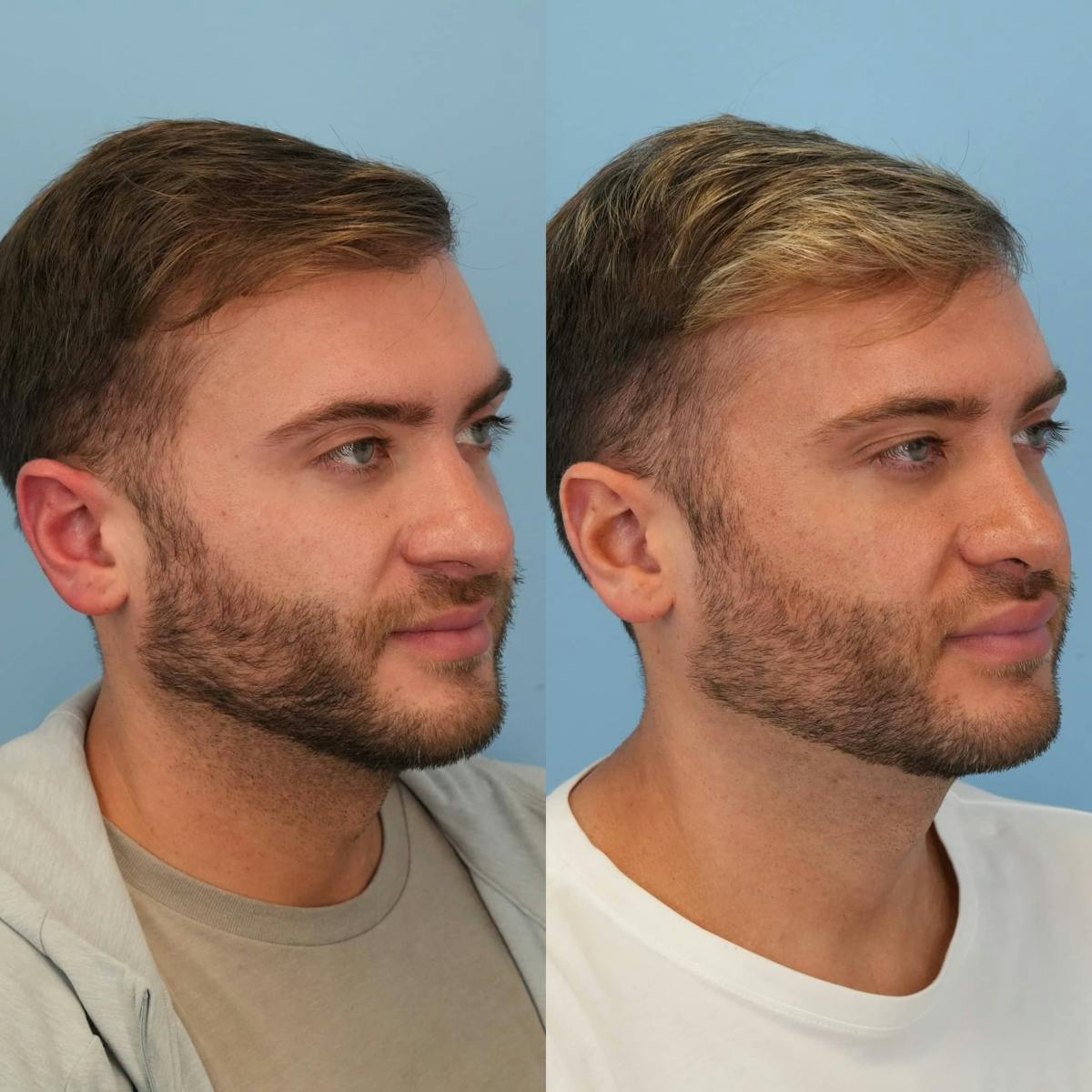 Rhinoplasty Before & After Gallery - Patient 167408 - Image 4