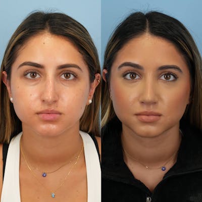 Rhinoplasty Before & After Gallery - Patient 574493 - Image 1