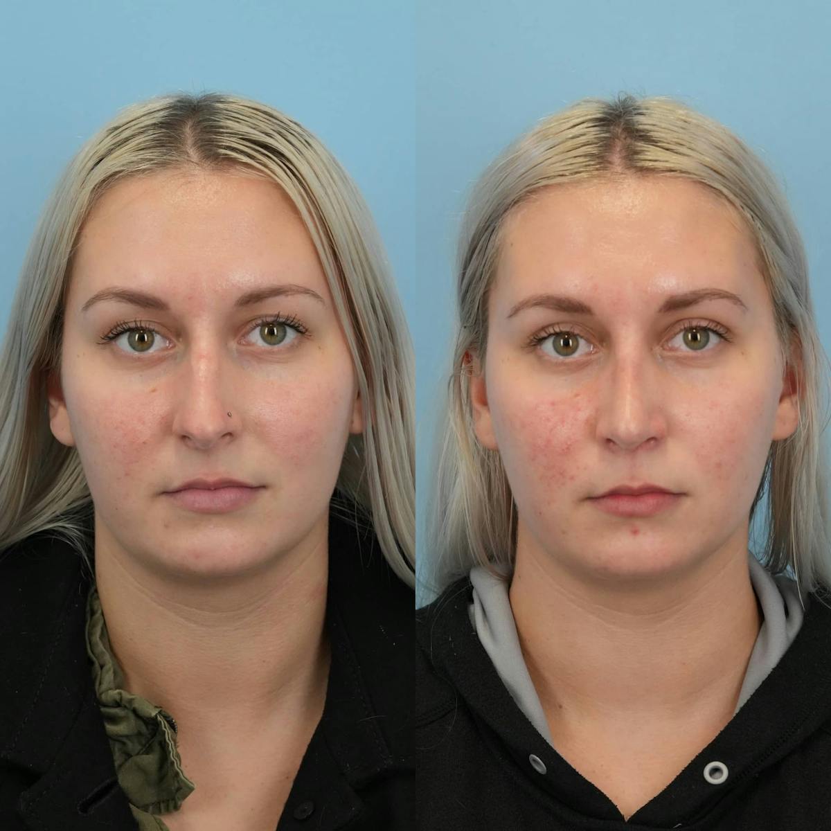 Rhinoplasty Before & After Gallery - Patient 109865 - Image 1