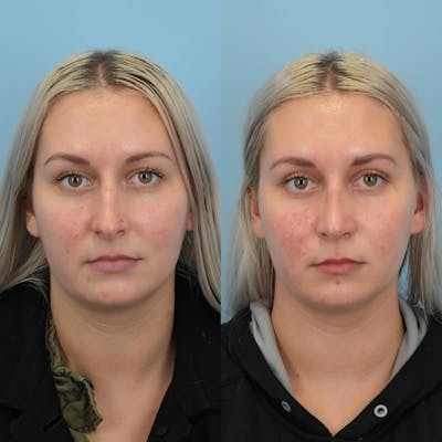 Rhinoplasty Before & After Gallery - Patient 109865 - Image 1