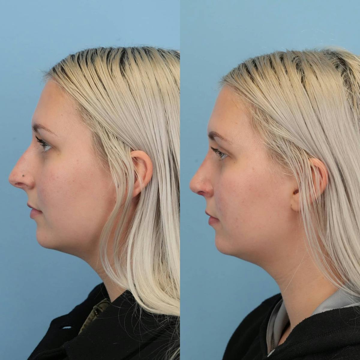 Rhinoplasty Before & After Gallery - Patient 109865 - Image 2