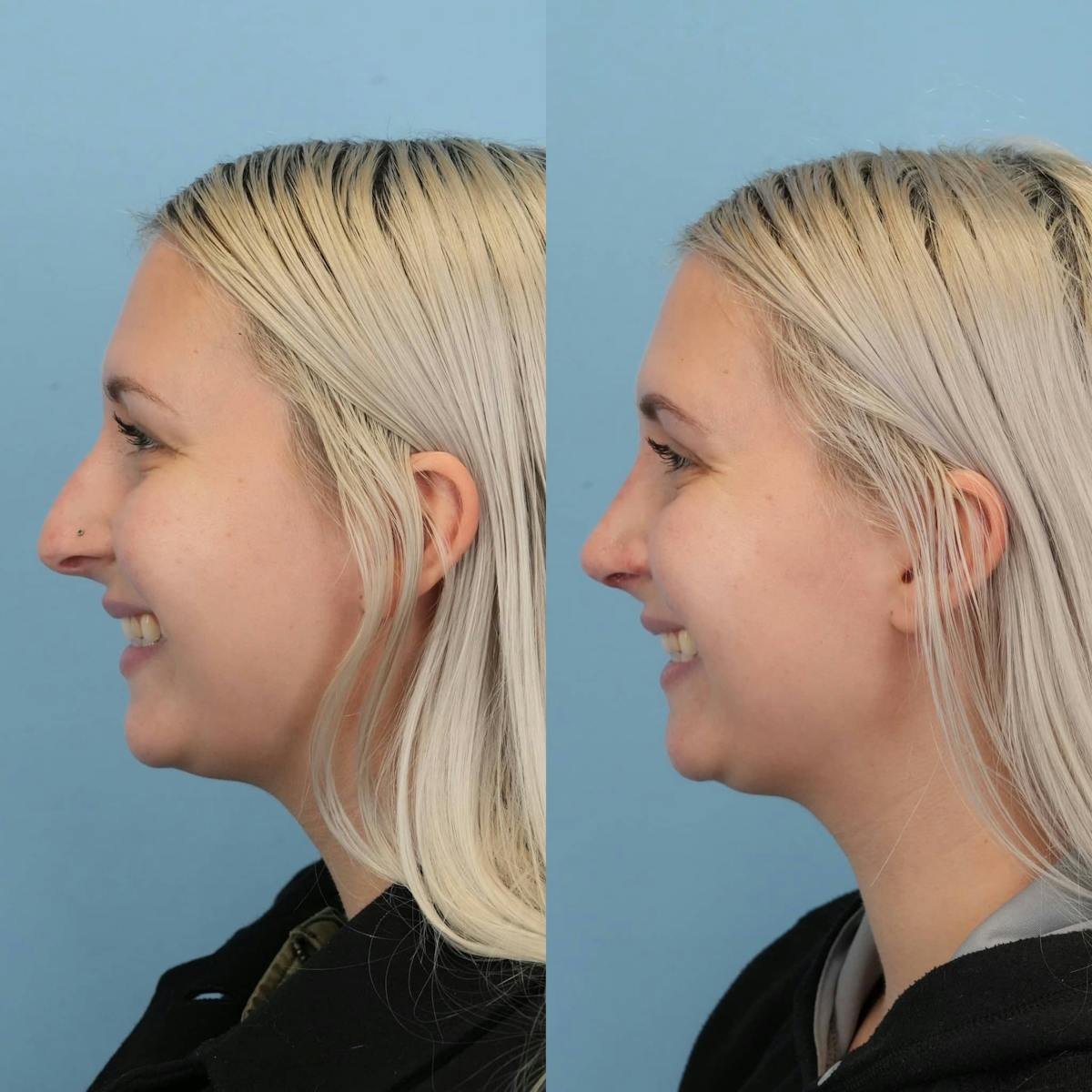 Rhinoplasty Before & After Gallery - Patient 109865 - Image 3