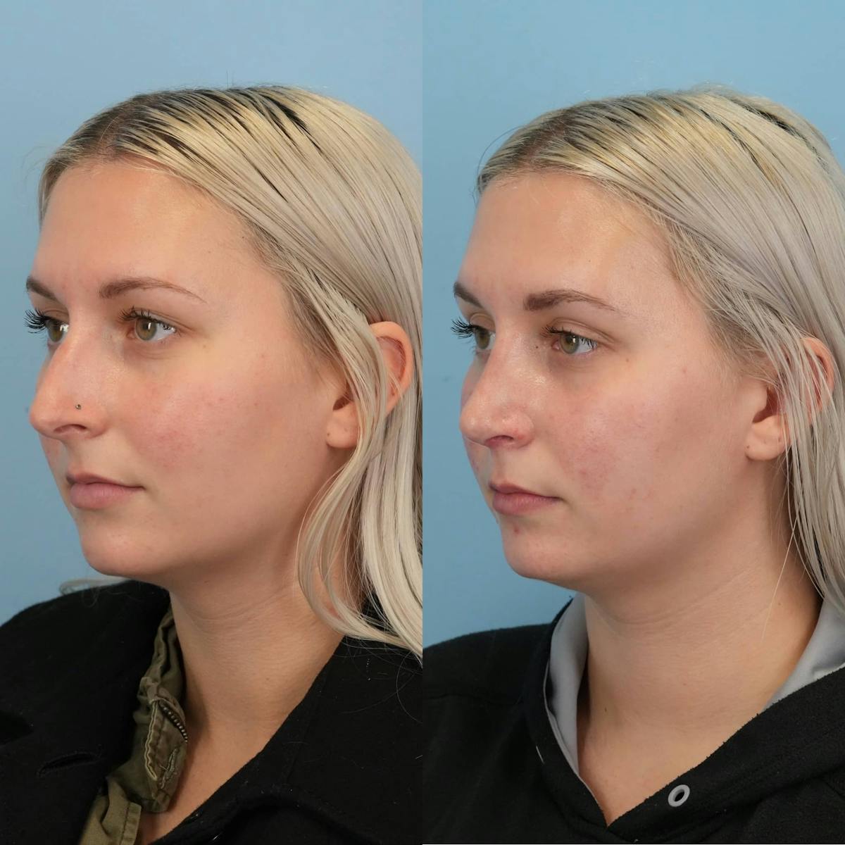 Rhinoplasty Before & After Gallery - Patient 109865 - Image 4