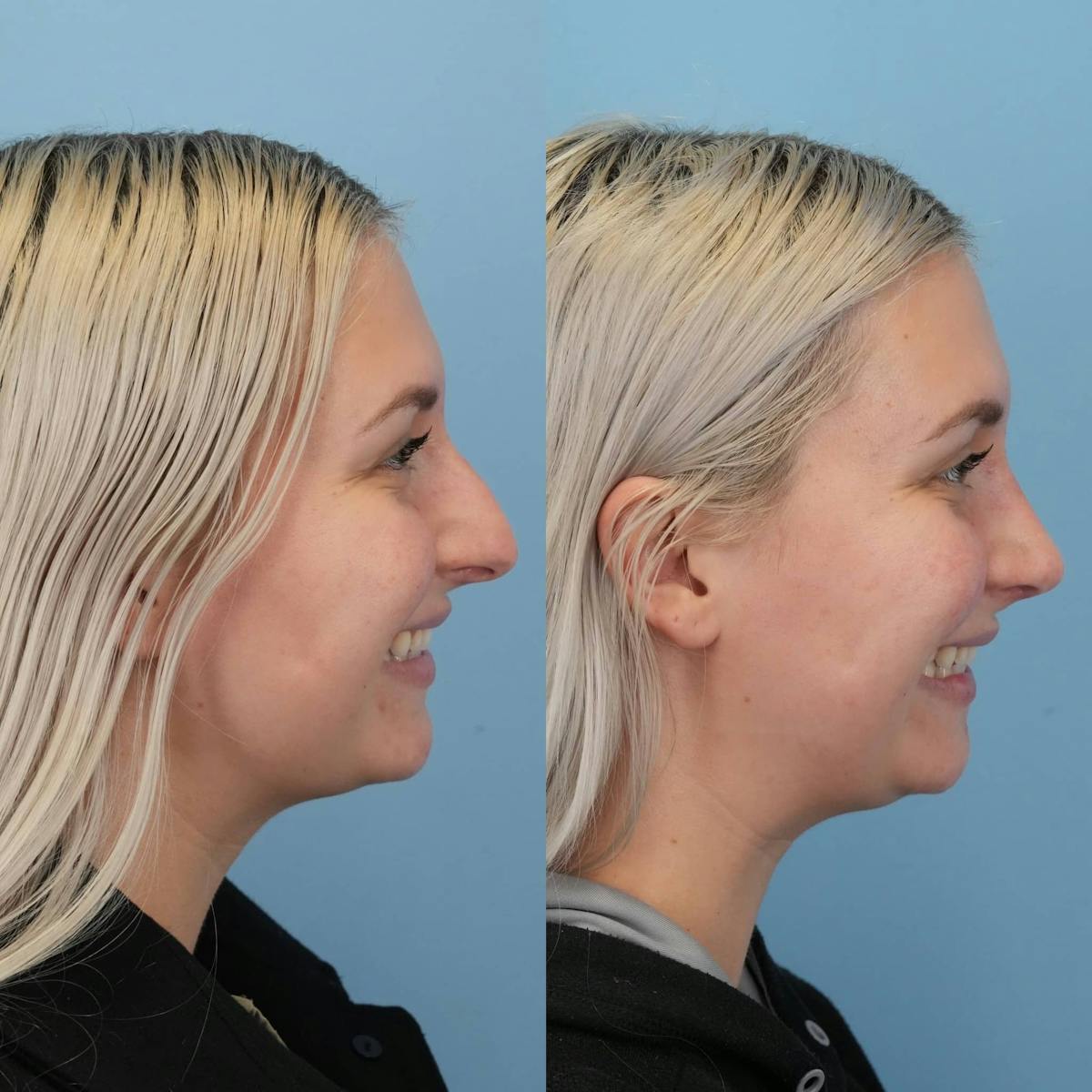 Rhinoplasty Before & After Gallery - Patient 109865 - Image 5