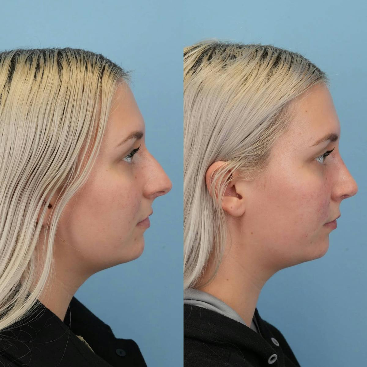 Rhinoplasty Before & After Gallery - Patient 109865 - Image 6