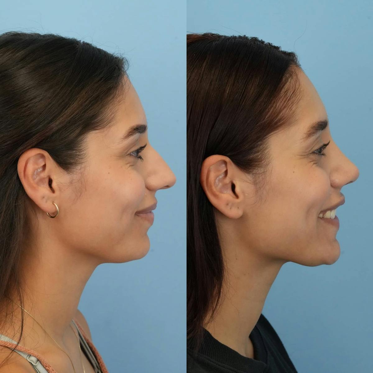 Rhinoplasty Before & After Gallery - Patient 267736 - Image 6