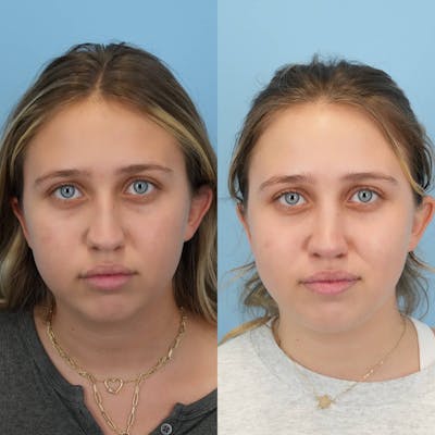Rhinoplasty Before & After Gallery - Patient 427519 - Image 1