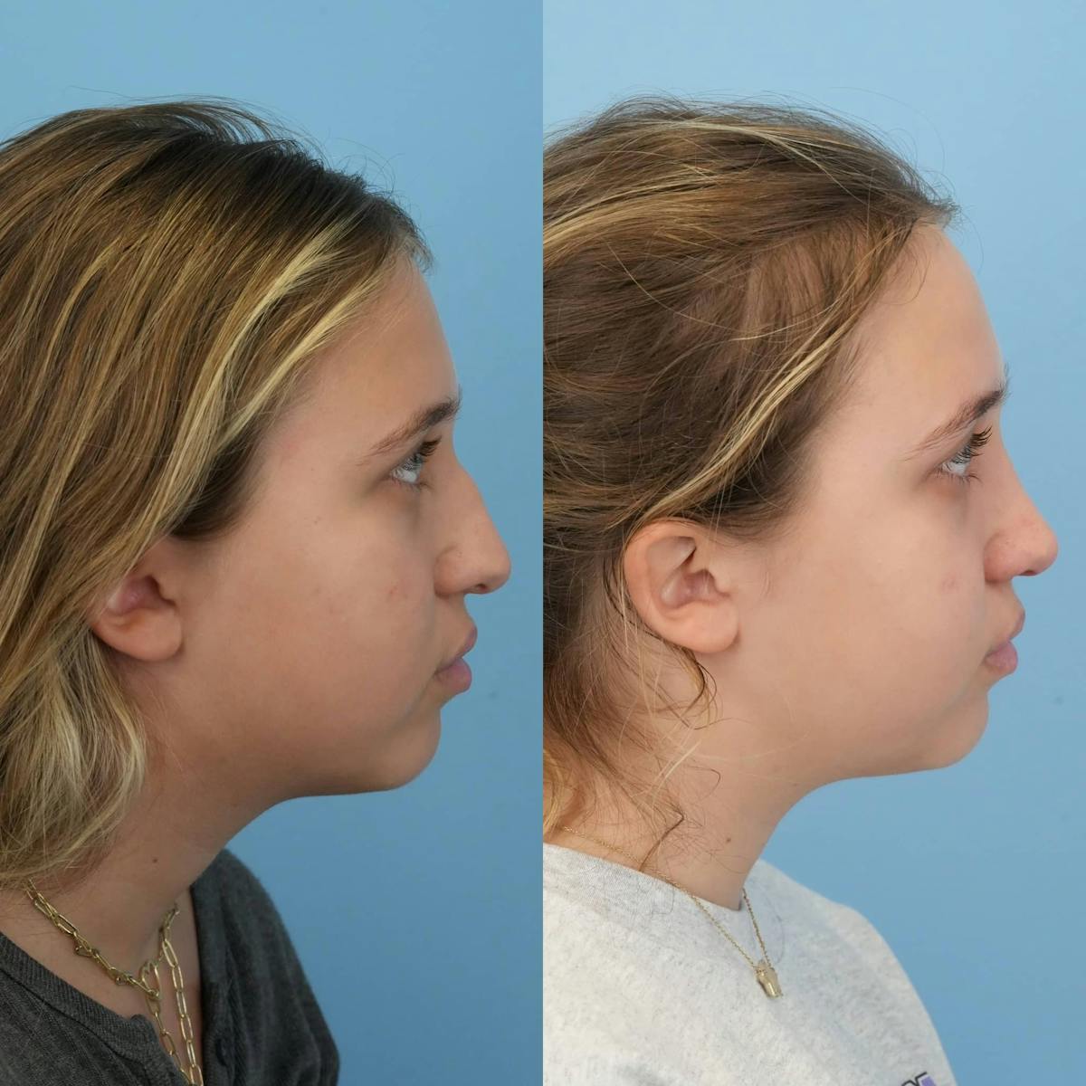 Rhinoplasty Before & After Gallery - Patient 427519 - Image 6