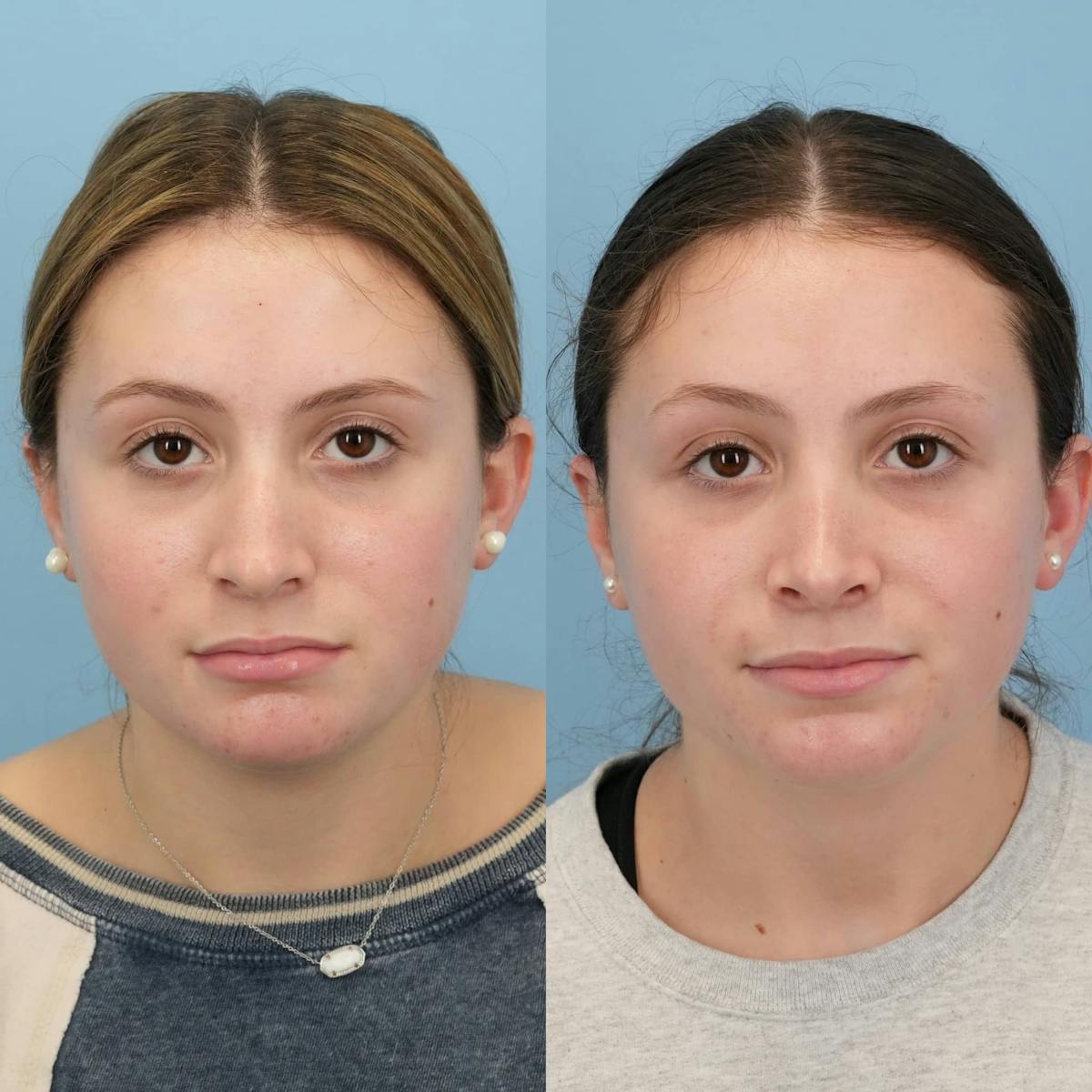 Rhinoplasty Before & After Gallery - Patient 313043 - Image 1