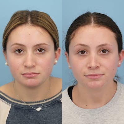 Rhinoplasty Before & After Gallery - Patient 313043 - Image 1