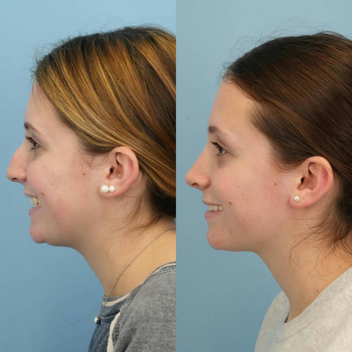 Rhinoplasty Before & After Gallery - Patient 313043 - Image 2