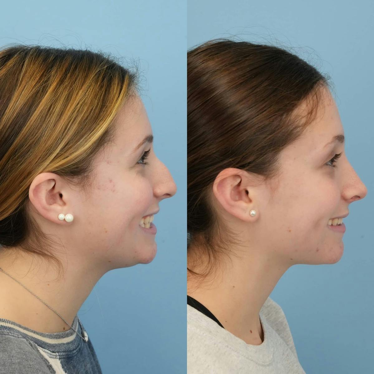 Rhinoplasty Before & After Gallery - Patient 313043 - Image 7