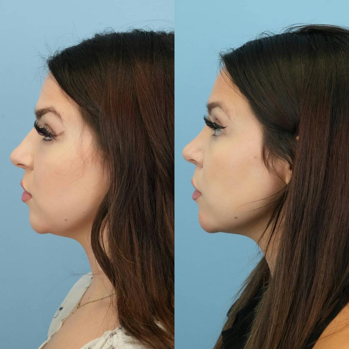 Rhinoplasty Before & After Gallery - Patient 179132 - Image 2