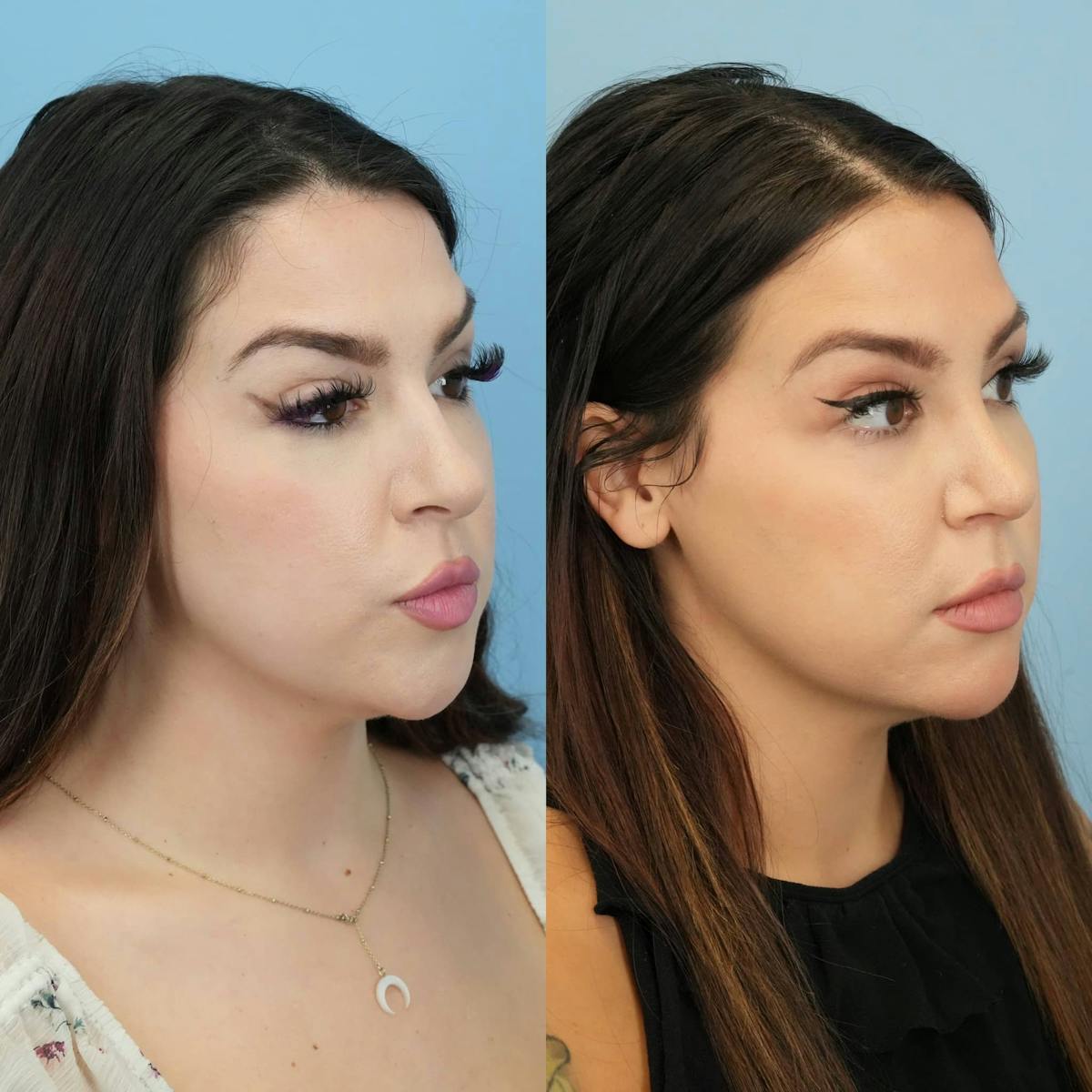 Rhinoplasty Before & After Gallery - Patient 179132 - Image 4