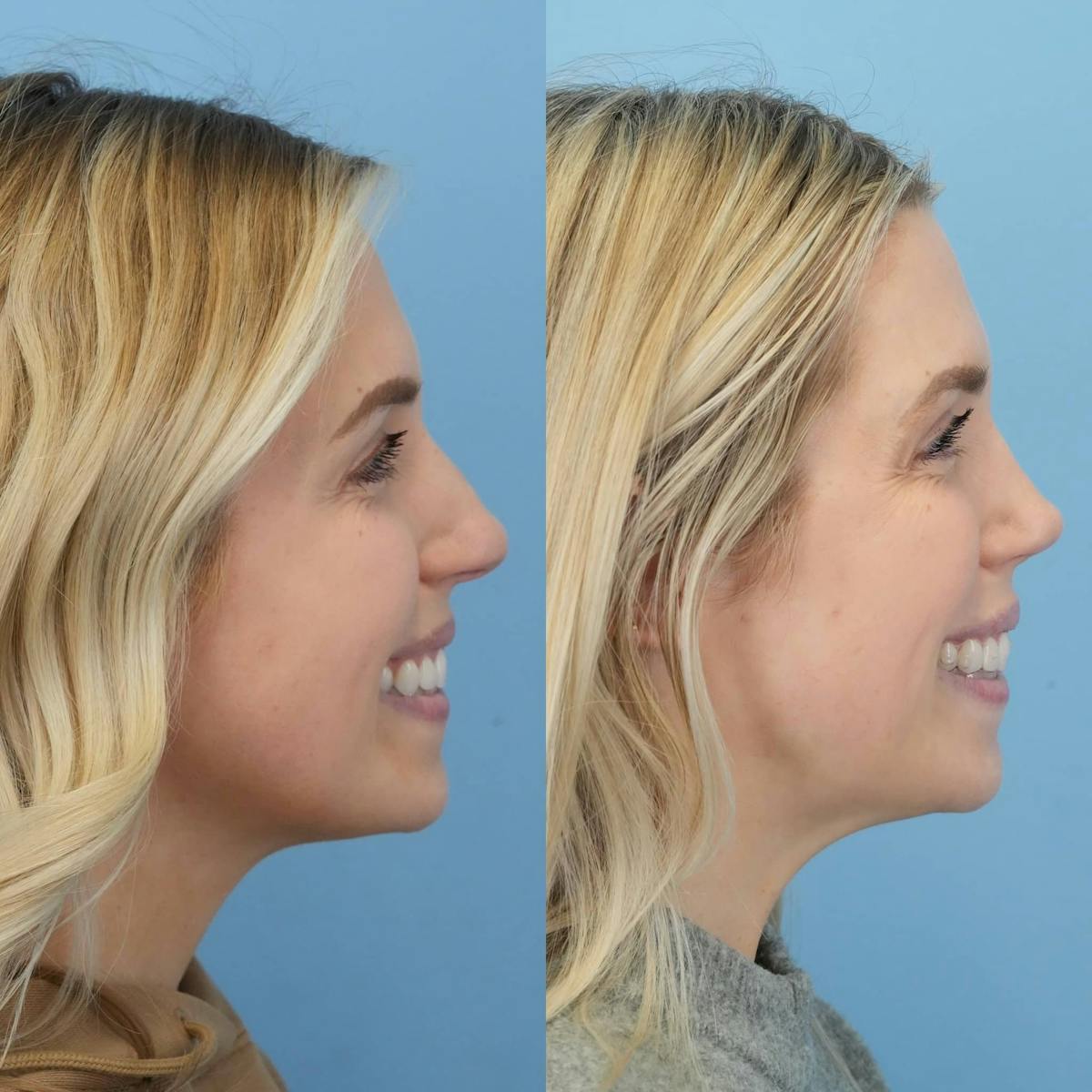 Rhinoplasty Before & After Gallery - Patient 107497 - Image 2