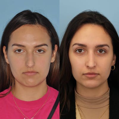 Rhinoplasty Before & After Gallery - Patient 207135 - Image 1