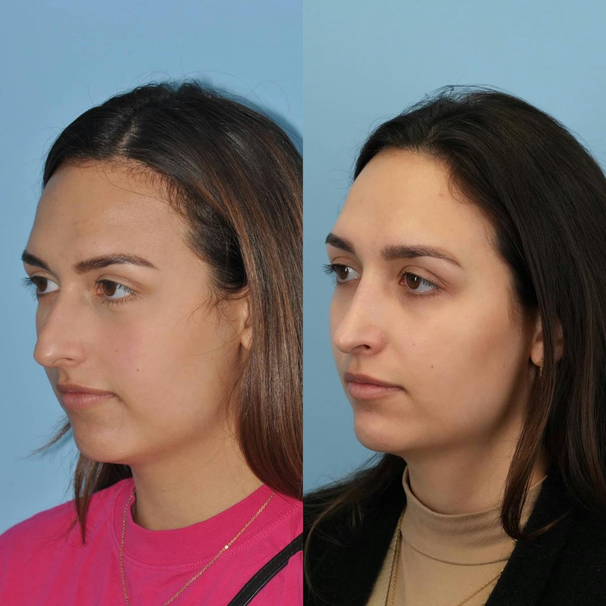 Rhinoplasty Before & After Gallery - Patient 207135 - Image 2