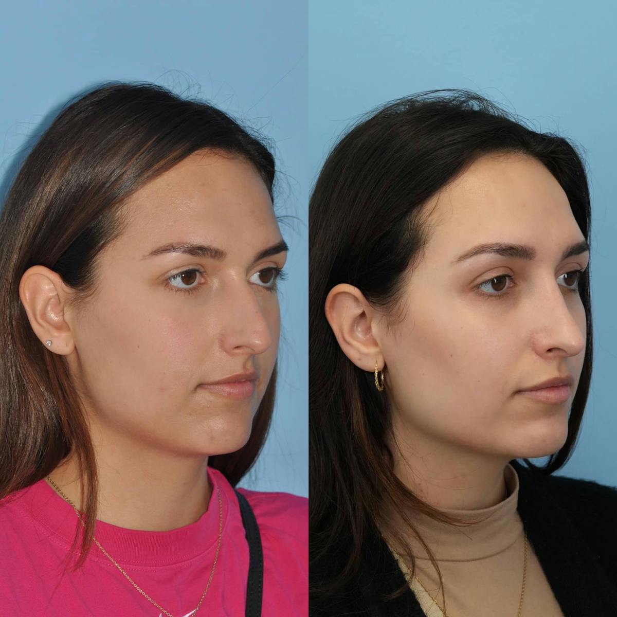 Rhinoplasty Before & After Gallery - Patient 207135 - Image 5