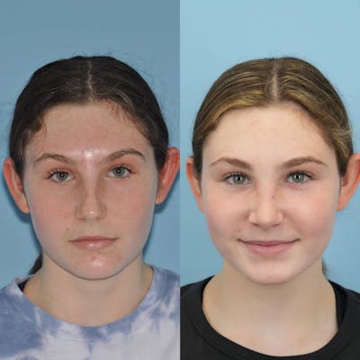 Rhinoplasty Before & After Gallery - Patient 130673 - Image 1