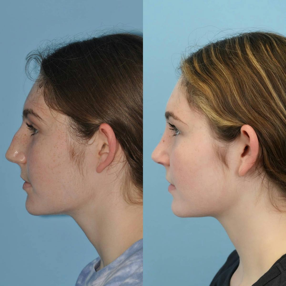 Rhinoplasty Before & After Gallery - Patient 130673 - Image 6