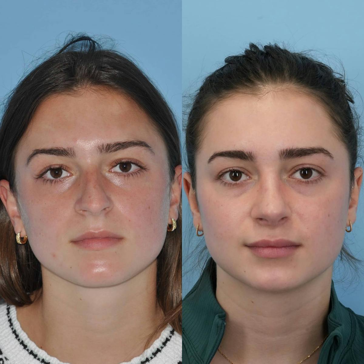 Rhinoplasty Before & After Gallery - Patient 323574 - Image 1
