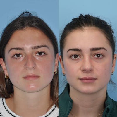 Rhinoplasty Before & After Gallery - Patient 323574 - Image 1