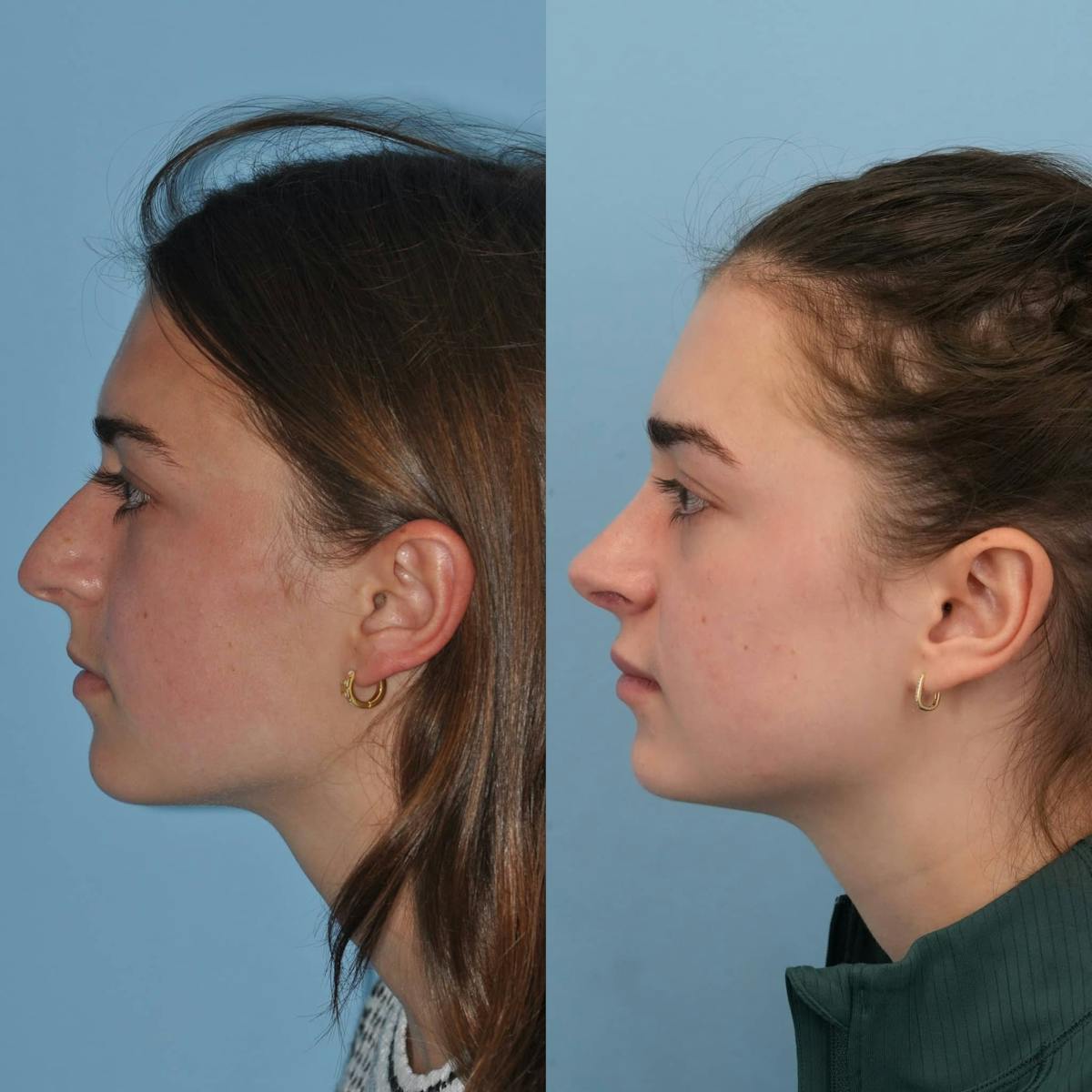 Rhinoplasty Before & After Gallery - Patient 323574 - Image 2