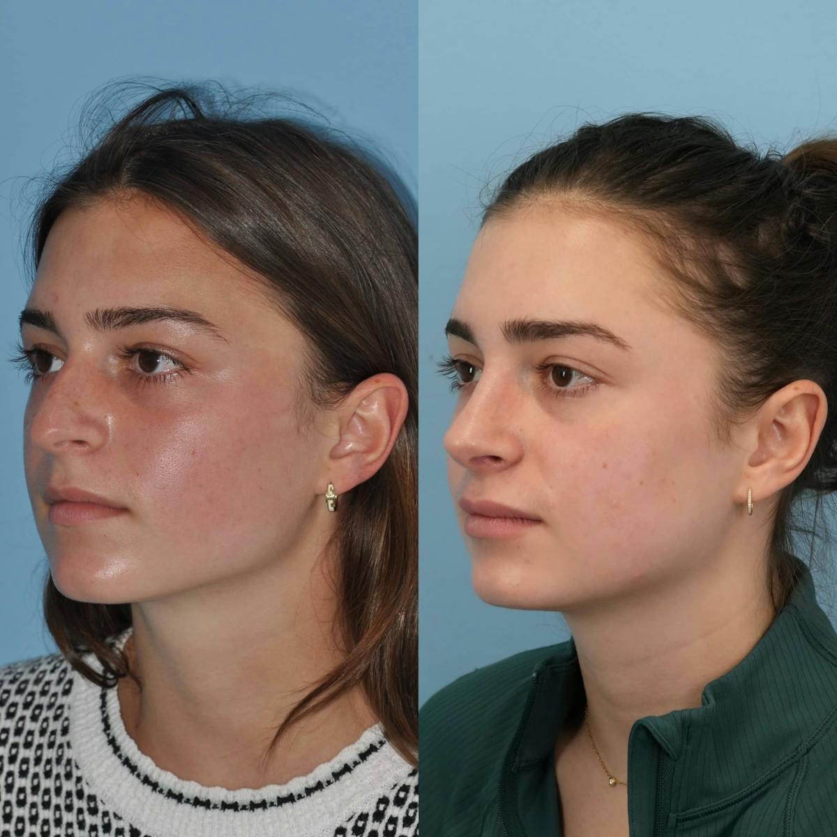 Rhinoplasty Before & After Gallery - Patient 323574 - Image 3