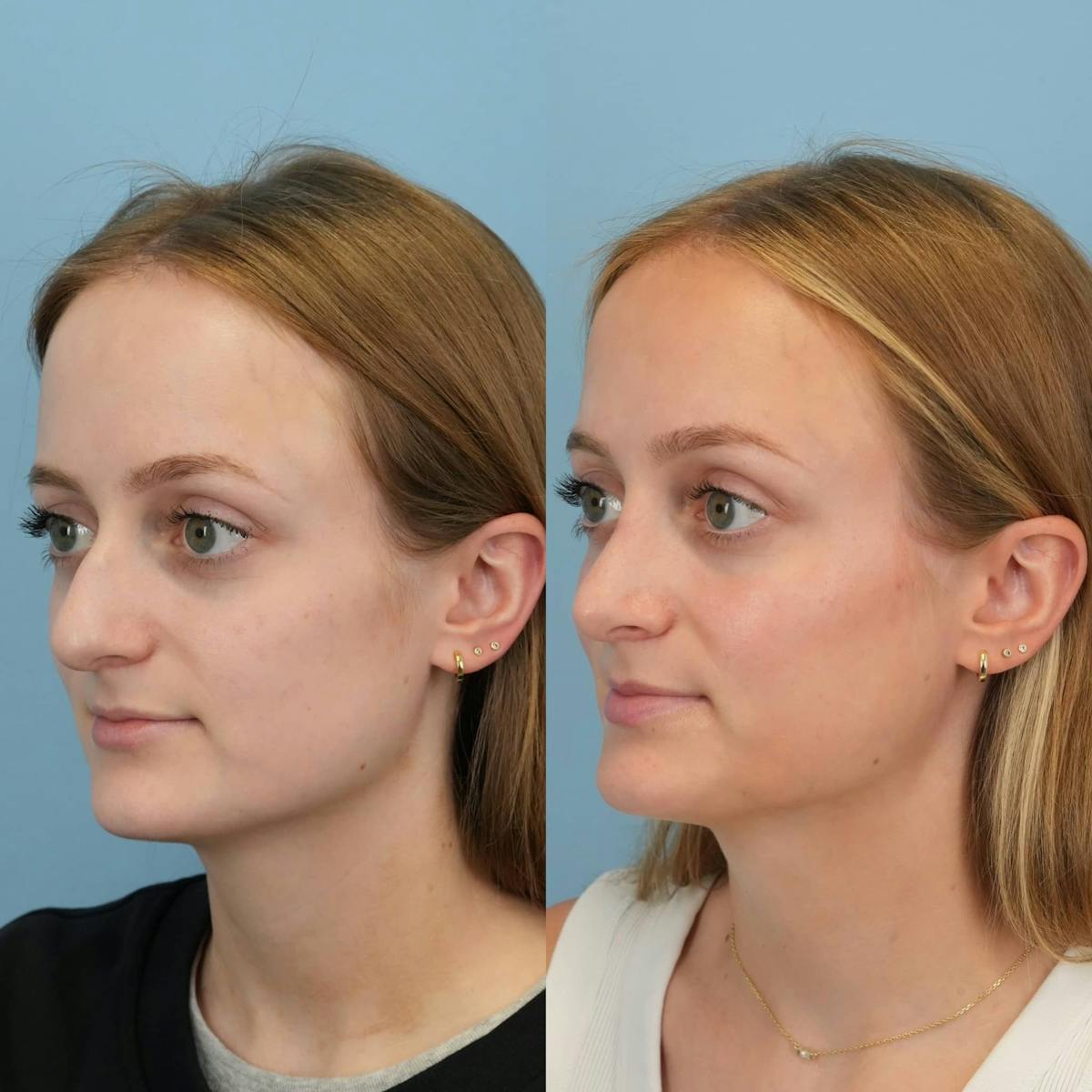 Rhinoplasty Before & After Gallery - Patient 369875 - Image 4