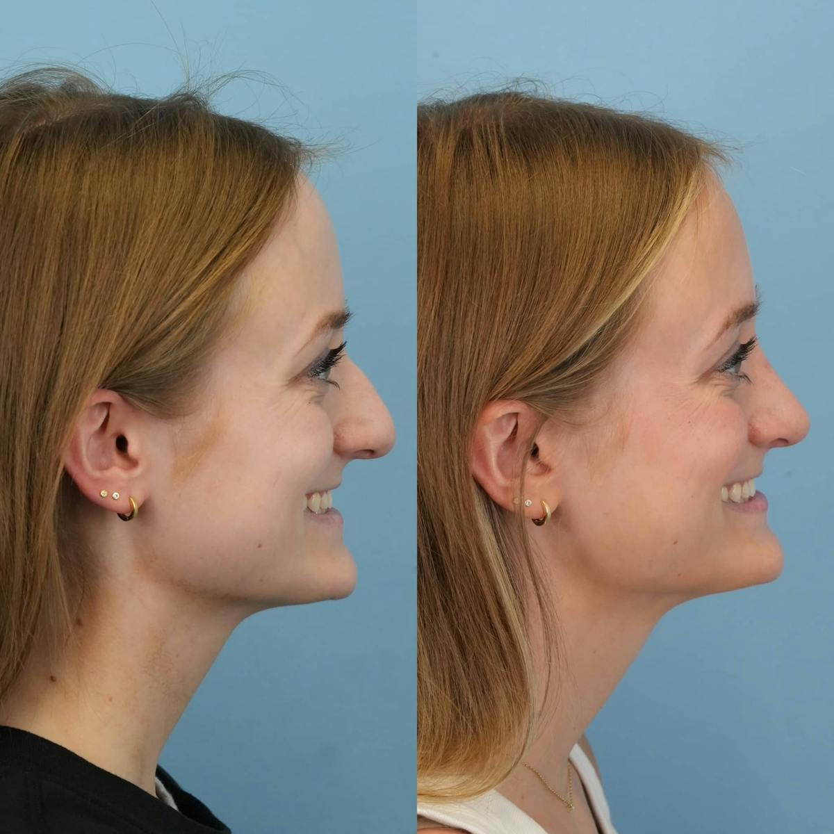 Rhinoplasty Before & After Gallery - Patient 369875 - Image 5