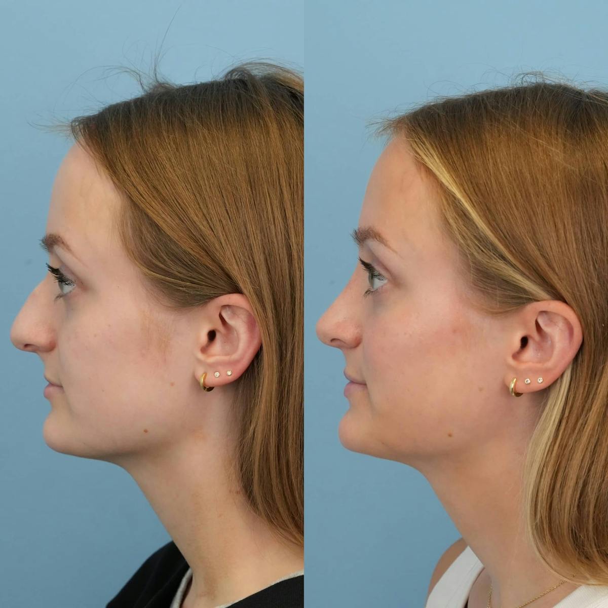 Rhinoplasty Before & After Gallery - Patient 369875 - Image 6