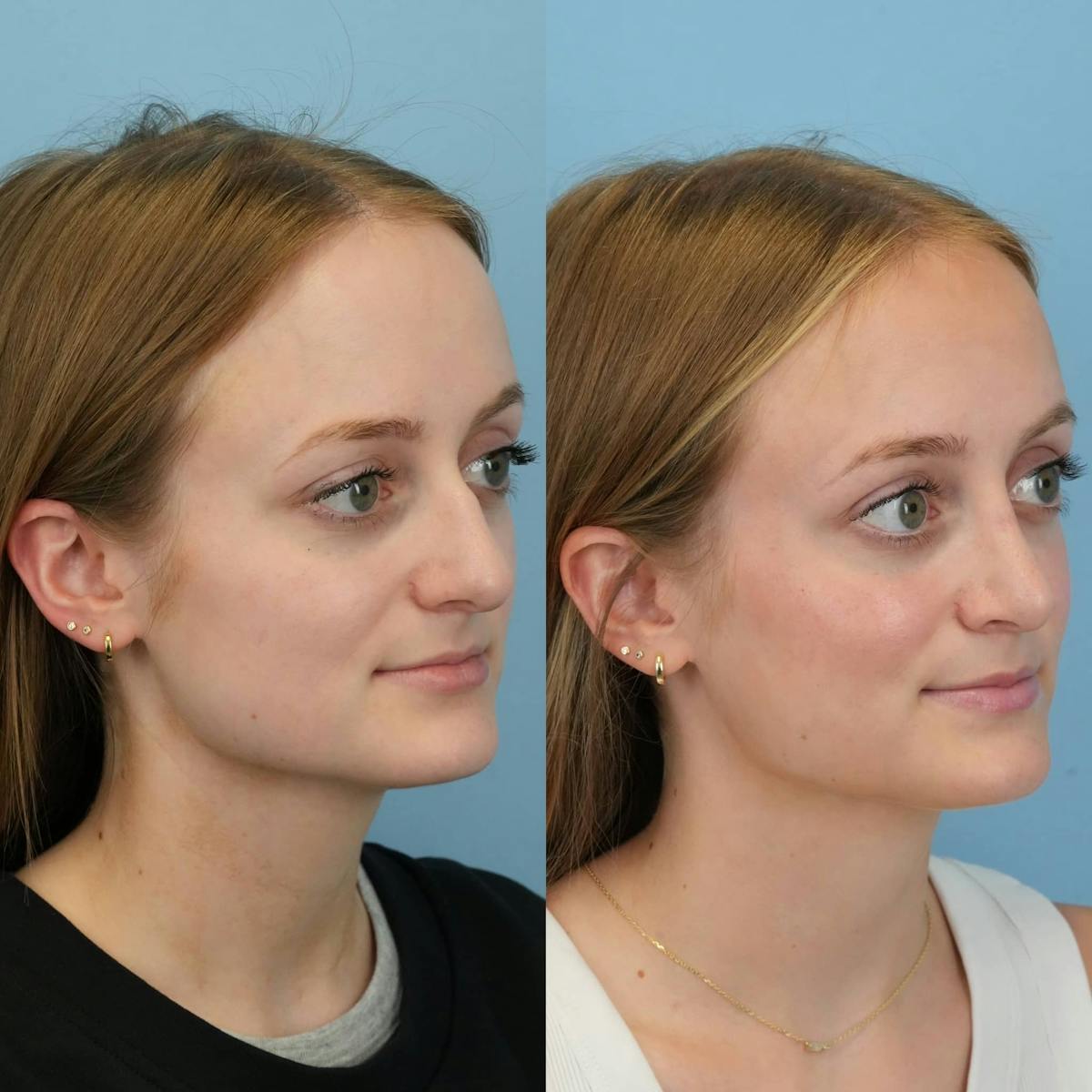 Rhinoplasty Before & After Gallery - Patient 369875 - Image 7