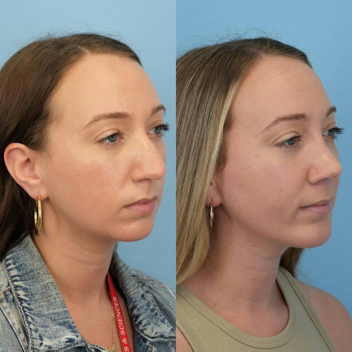 Rhinoplasty Before & After Gallery - Patient 263562 - Image 7