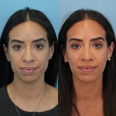 Rhinoplasty Before & After Gallery - Patient 614984 - Image 1