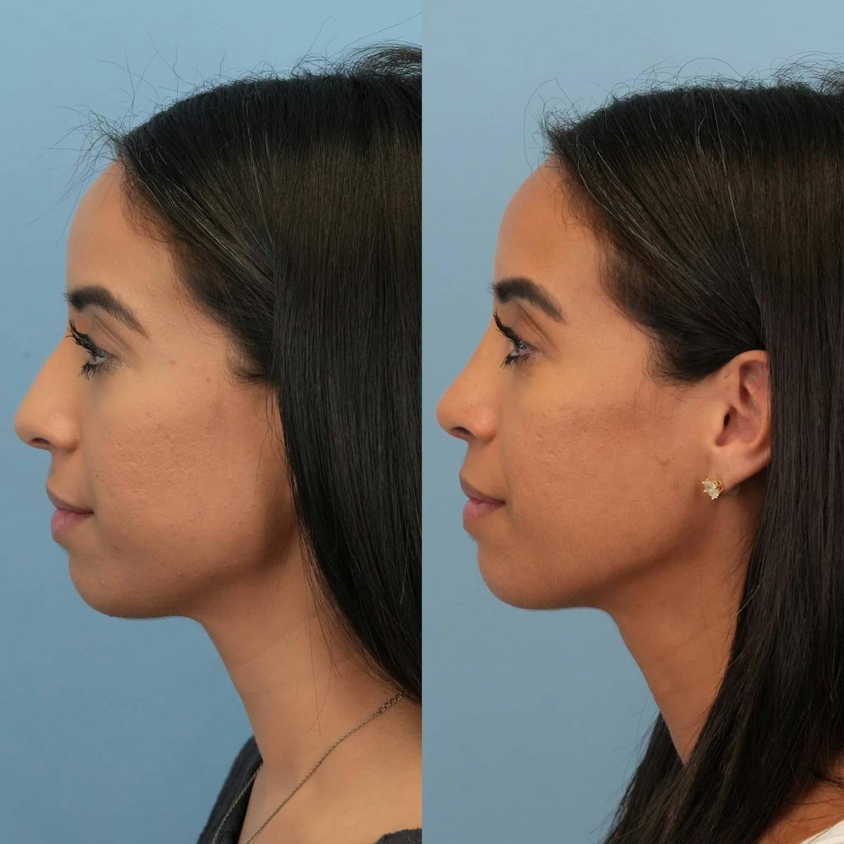 Rhinoplasty Before & After Gallery - Patient 614984 - Image 2