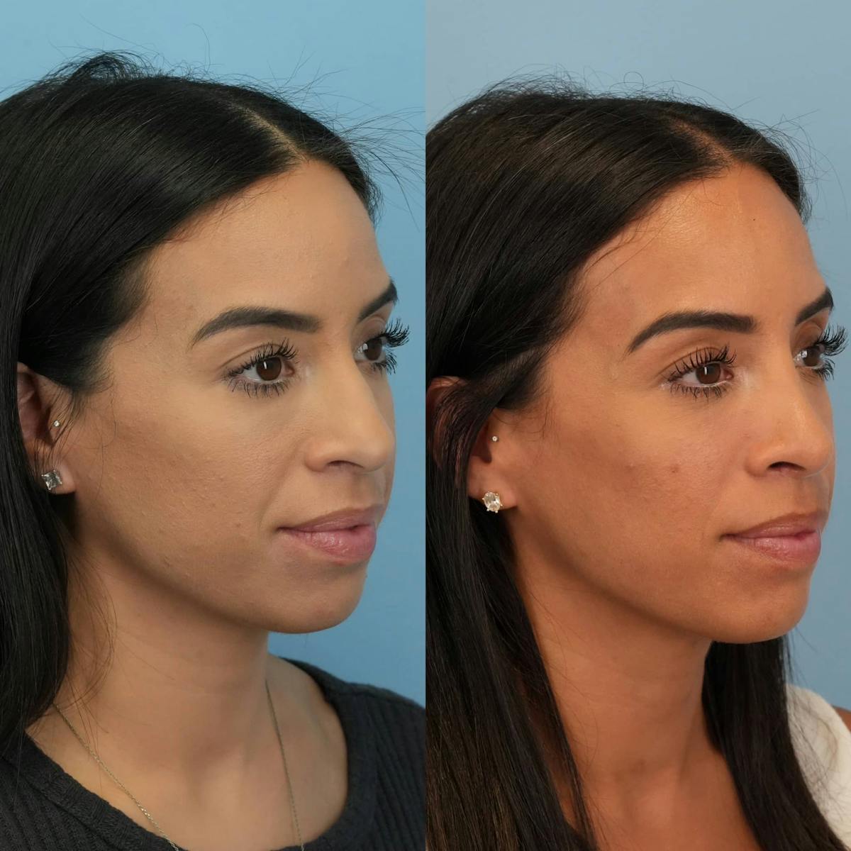 Rhinoplasty Before & After Gallery - Patient 614984 - Image 3