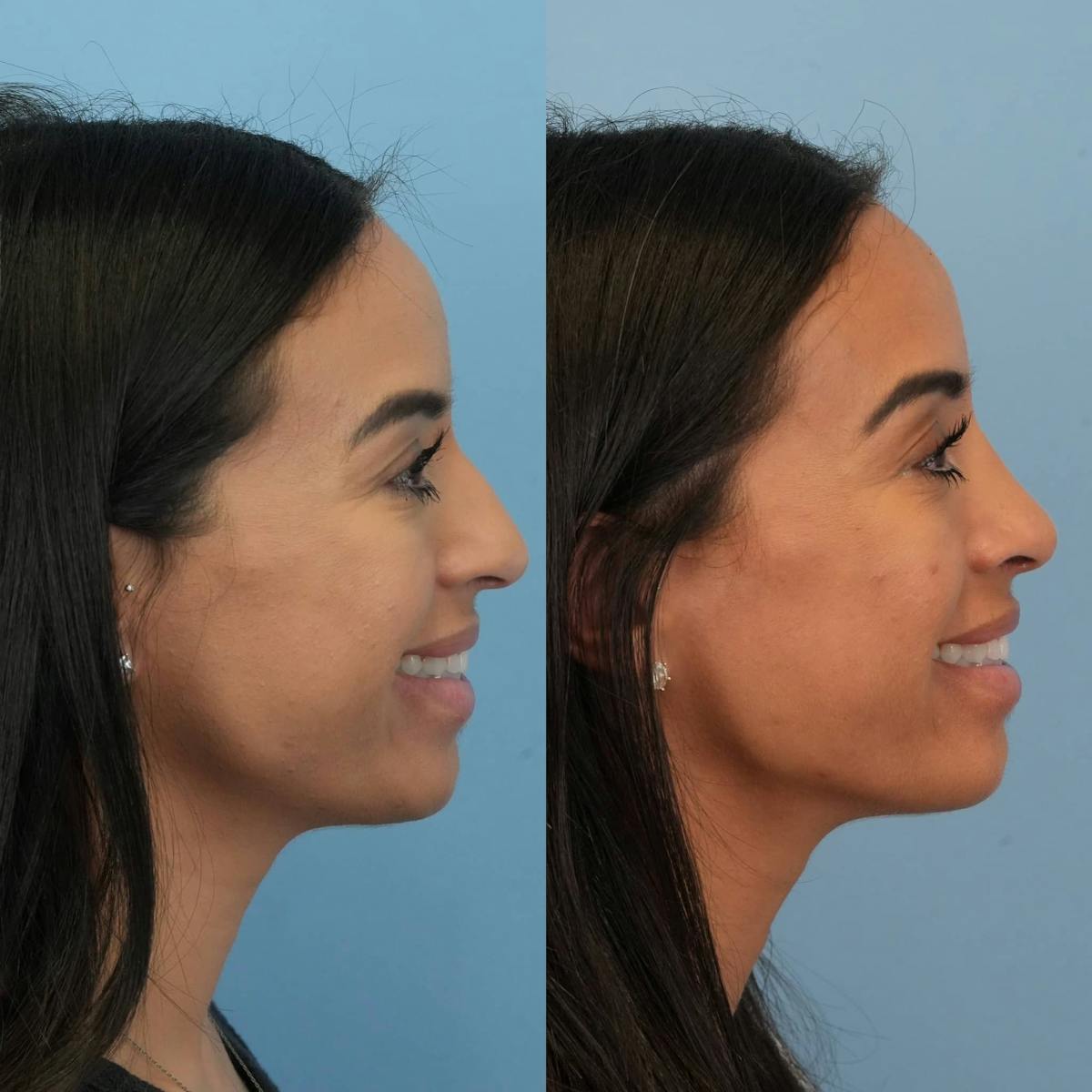Rhinoplasty Before & After Gallery - Patient 614984 - Image 4