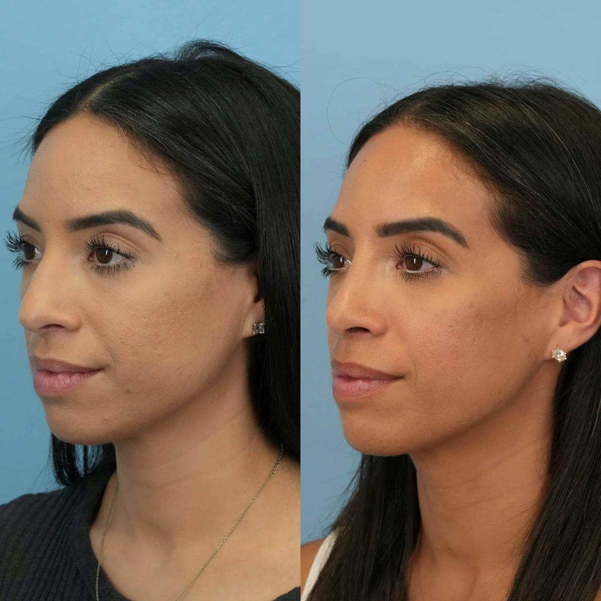 Rhinoplasty Before & After Gallery - Patient 614984 - Image 5
