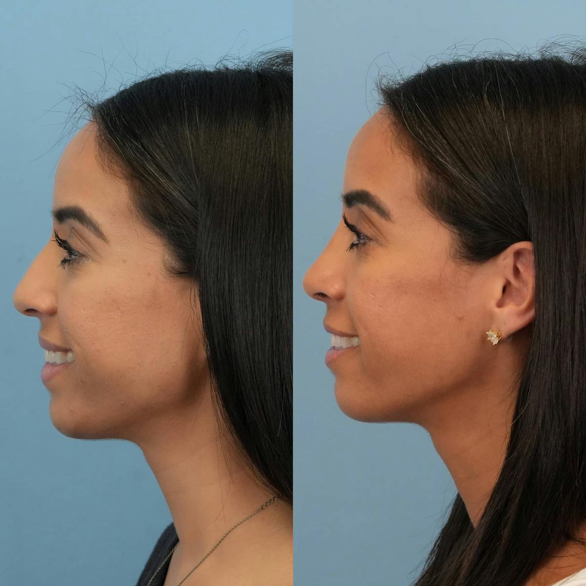 Rhinoplasty Before & After Gallery - Patient 614984 - Image 6