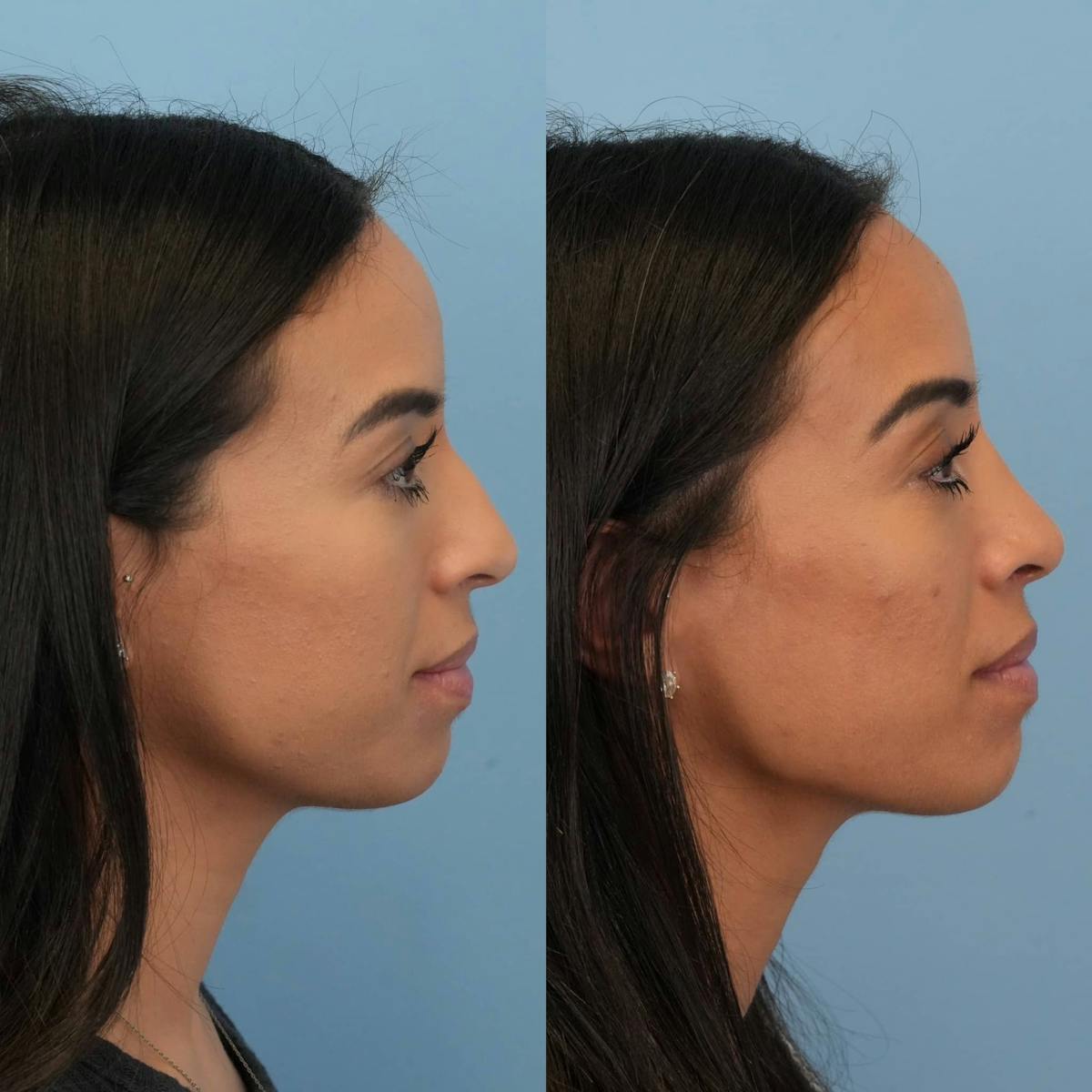 Rhinoplasty Before & After Gallery - Patient 614984 - Image 7