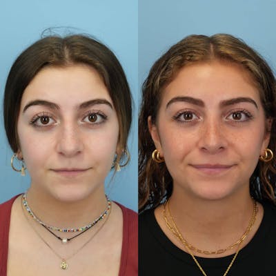 Rhinoplasty Before & After Gallery - Patient 384667 - Image 1