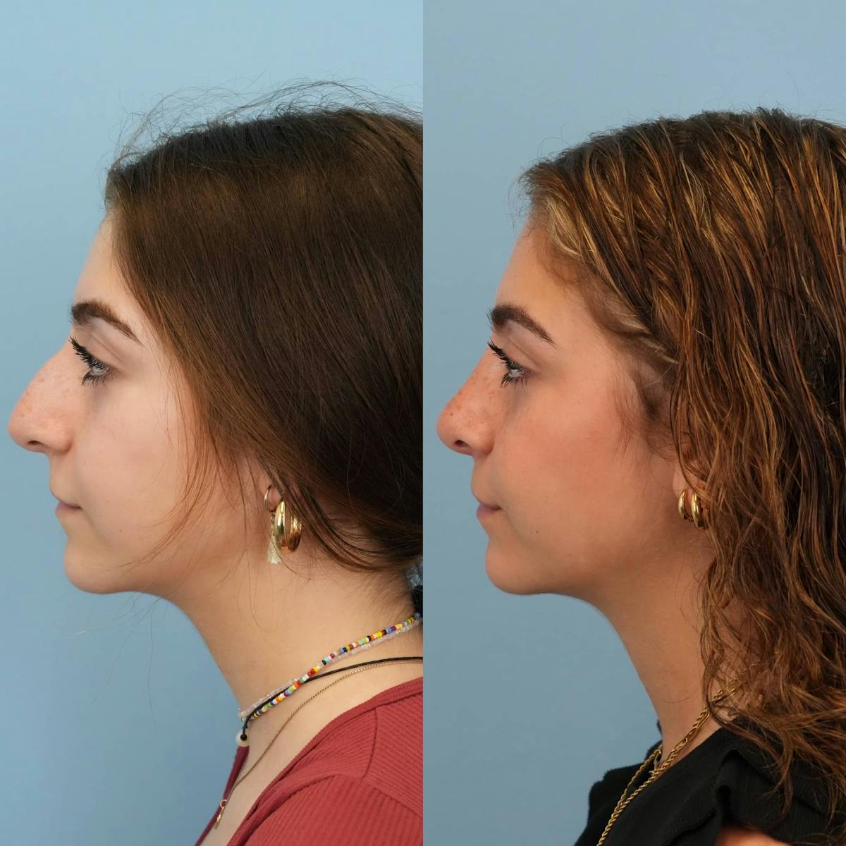 Rhinoplasty Before & After Gallery - Patient 384667 - Image 2