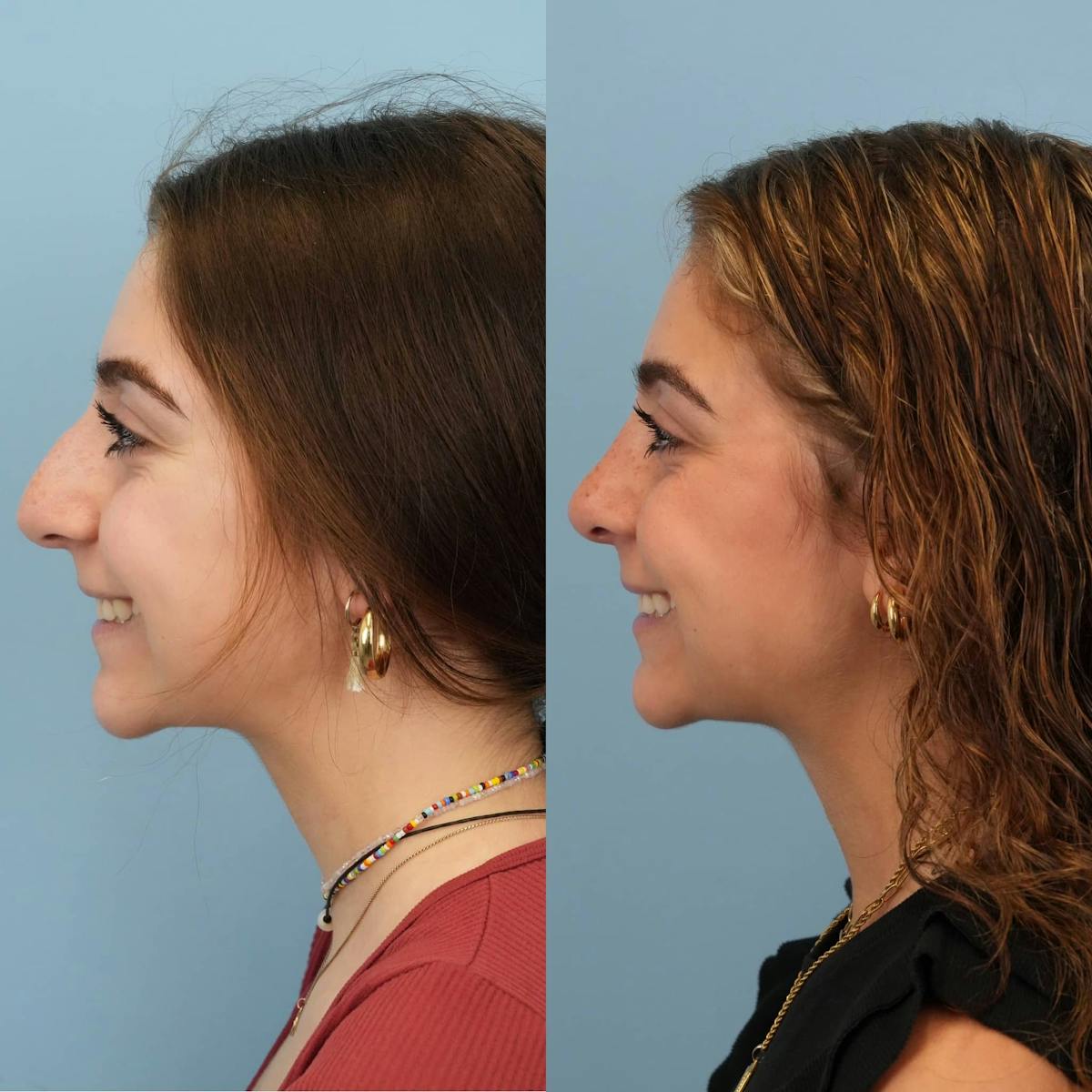 Rhinoplasty Before & After Gallery - Patient 384667 - Image 3