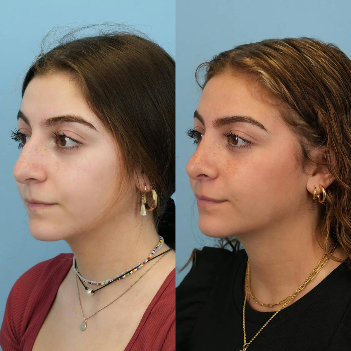 Rhinoplasty Before & After Gallery - Patient 384667 - Image 4