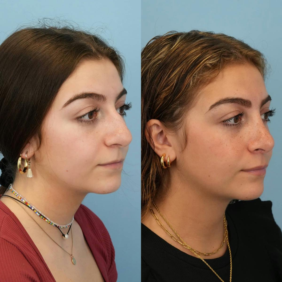 Rhinoplasty Before & After Gallery - Patient 384667 - Image 6