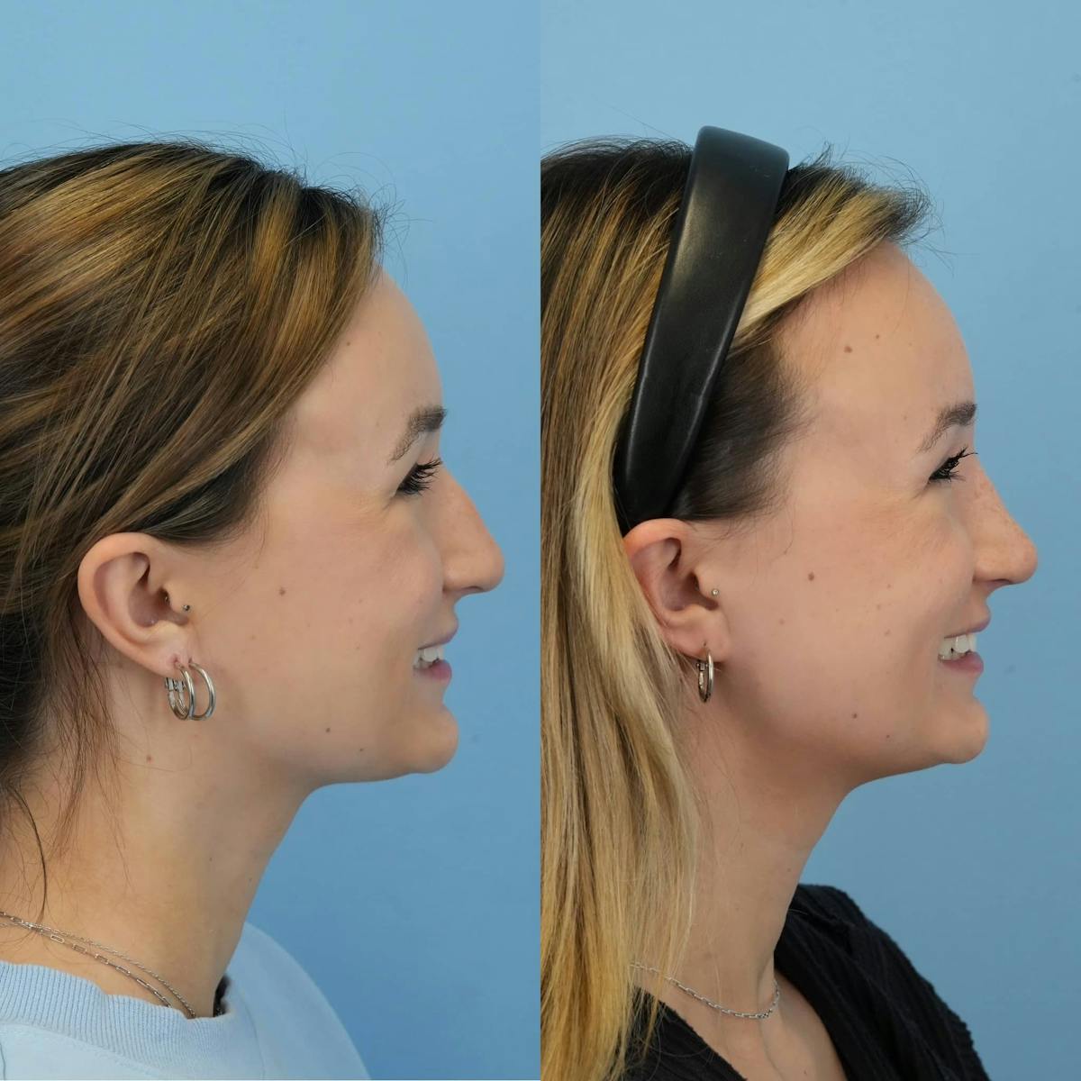 Rhinoplasty Before & After Gallery - Patient 187937 - Image 8