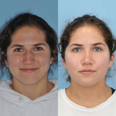 Rhinoplasty Before & After Gallery - Patient 384144 - Image 1